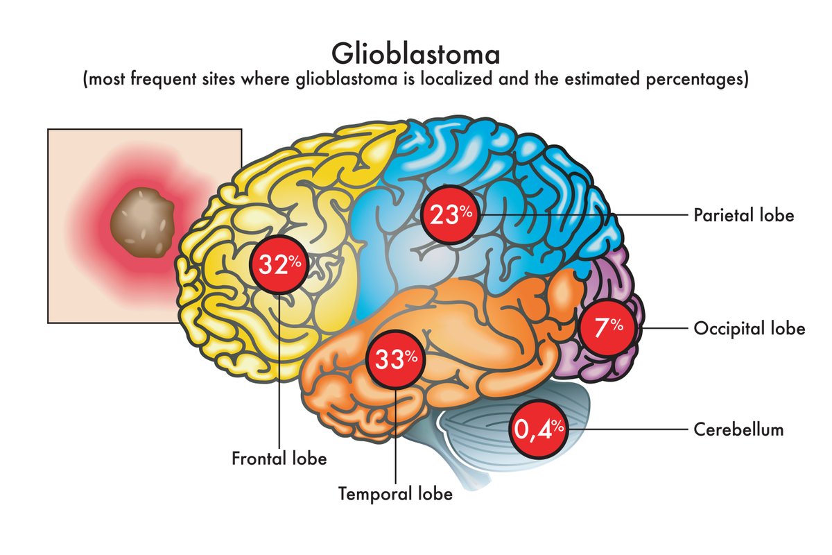 CureusNeuro's tweet photo. Navigating glioblastoma treatment terrain. 🧠 Latest insights on surgery, radiation, temozolomide, and innovative therapies.
https://t.co/KxrZPv0Eu0
#BrainTumorAwareness #MedicalResearch #Glioblastoma #NeurologyUpdate #HealthInnovation #meded #foamed #medtwitter https://t.co/YN5zOtvP1y