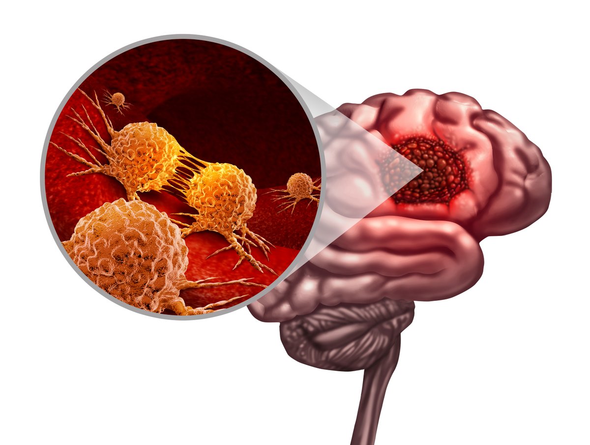 CureusNeuro's tweet photo. Navigating glioblastoma treatment terrain. 🧠 Latest insights on surgery, radiation, temozolomide, and innovative therapies.
https://t.co/KxrZPv0Eu0
#BrainTumorAwareness #MedicalResearch #Glioblastoma #NeurologyUpdate #HealthInnovation #meded #foamed #medtwitter https://t.co/YN5zOtvP1y