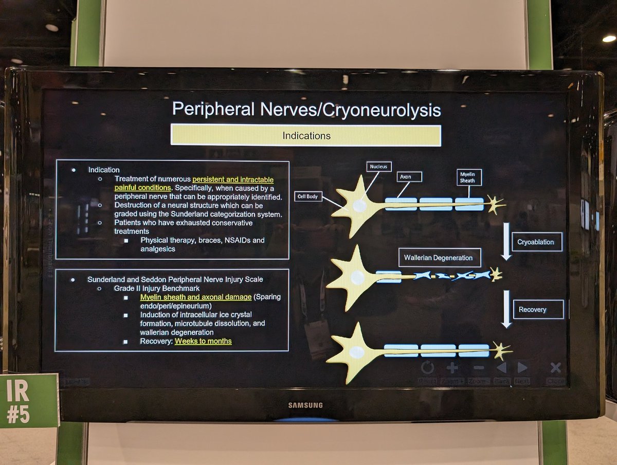 Fred Bertino, MD (@fredbertinomd) on Twitter photo Luis Garza-Barrera and team at <a href="/NYURadRes/">NYU Radiology Residency</a> <a href="/nyuVIR/">NYU VIR</a> assembled this proof of concept exhibit for #RSNA23 on whole-body cryoablation application with our friends <a href="/ChildrensATLRad/">Radiology Children's Healthcare of Atlanta</a> and @EmoryRadiology Luis Garza-Barrera and team at <a href="/NYURadRes/">NYU Radiology Residency</a> <a href="/nyuVIR/">NYU VIR</a> assembled this proof of concept exhibit for #RSNA23 on whole-body cryoablation application with our friends <a href="/ChildrensATLRad/">Radiology Children's Healthcare of Atlanta</a> and @EmoryRadiology