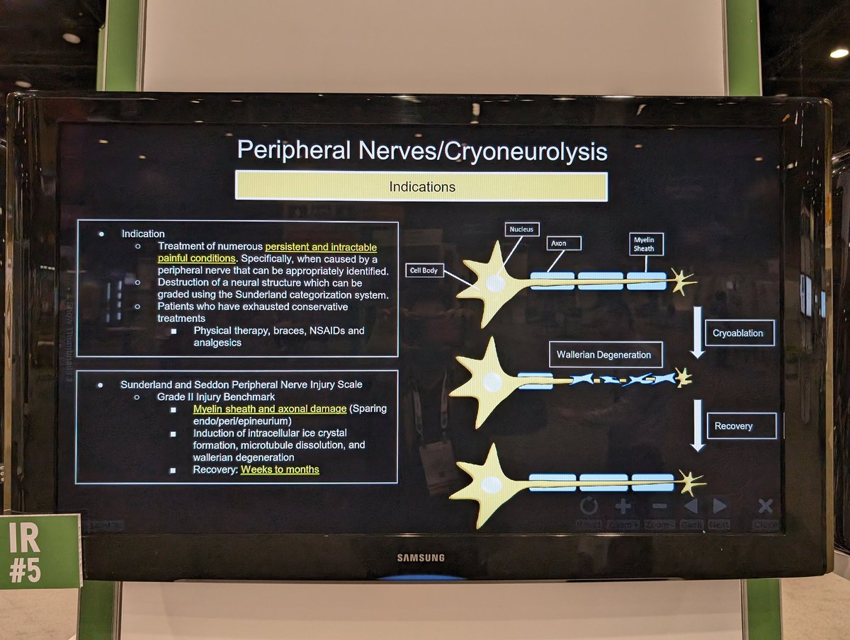 Luis Garza-Barrera and team at @NYURadRes @nyuVIR assembled this proof of concept exhibit for #RSNA23 on whole-body cryoablation application with our friends @ChildrensATLRad and @EmoryRadiology