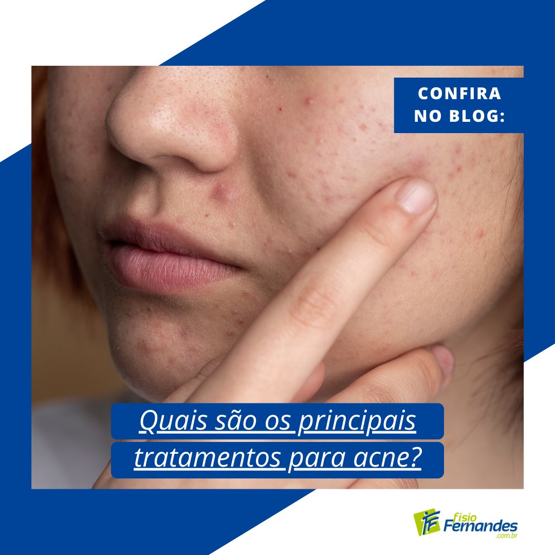 Conheça os principais tratamentos para acne além dos fatores relacionados ao aparecimento dessa patologia cutânea. 💆‍

📍 Veja o artigo completo no blog. tinyurl.com/5wkn2zvd

#Acne #FisioFernandes