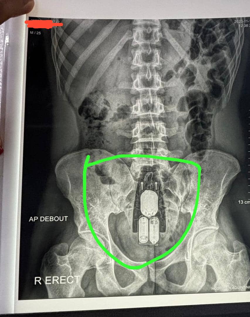 bakari_fils's tweet photo. A 25yrs old male who was got this vibratir extracted from his rectum https://t.co/pwLGjB5ewS