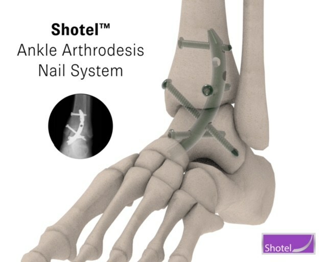 PRNHealth's tweet image. New Shotel™ Medical Ankle Arthrodesis Device Significantly Improves Patient Quality of Life ➡️ brnw.ch/21wEQ5z

#AnkleArthritis #Arthritis