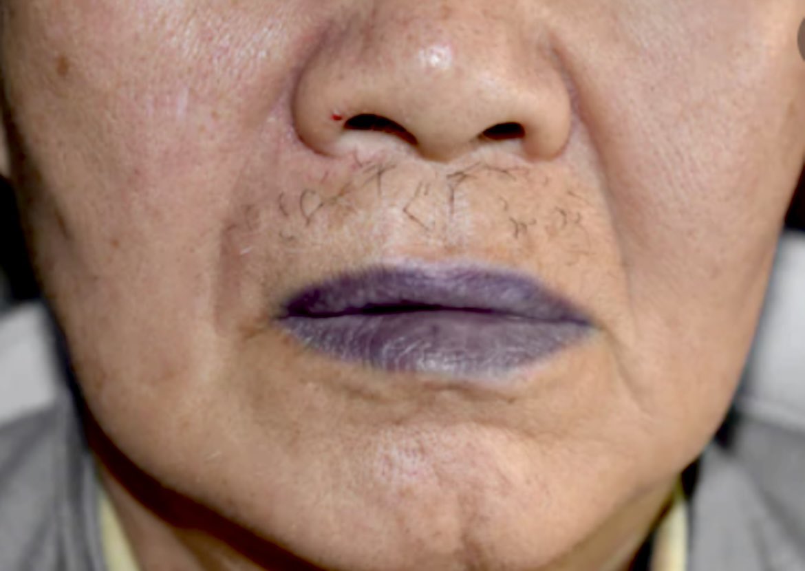 docxusofficial's tweet image. Patient’s SPO2 is 80% despite no lung pathology and clear airway

What do you suspect?

What’s the antidote ?