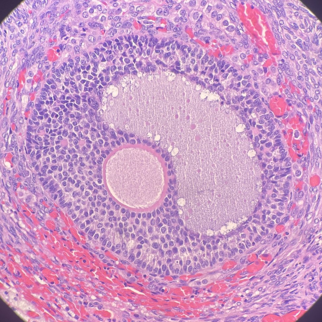 Just a lil ovarian follicle being perfect.

#gynpath #pathtwitter #pathx