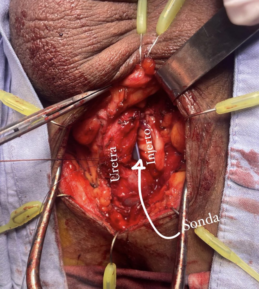 🚹 36 años. 
Estenosis de 3cm post trauma automovilístico y UTI previa, BMG de 5 cm y reconstrucción con técnica Kulkarni <a href="/sanjaybkulkarni/">Dr Sanjay Kulkarni</a>
W/<a href="/drecabeza/">Eduardo Cabeza Bucio</a>