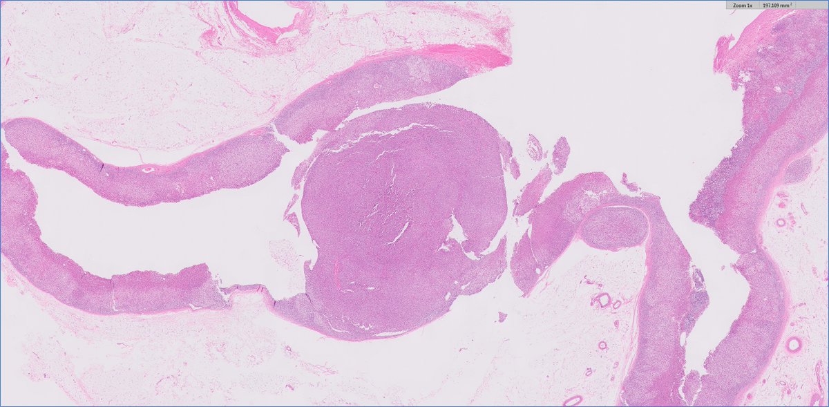 slusagar's tweet image. #endopath: 
😍🔬aldosterone-secreting adrenal cortical adenoma (Conn syndrome), s/p prior Rx  w/spironolactone

add'l learning points: 
- number of spironolactone bodies typically peaks 4-6 week after spironolactone Rx 
- usually DO NOT see bodies with novel Rx agent eplerenone