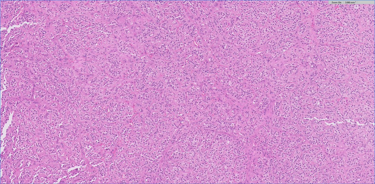 slusagar's tweet image. #endopath: 
😍🔬aldosterone-secreting adrenal cortical adenoma (Conn syndrome), s/p prior Rx  w/spironolactone

add'l learning points: 
- number of spironolactone bodies typically peaks 4-6 week after spironolactone Rx 
- usually DO NOT see bodies with novel Rx agent eplerenone