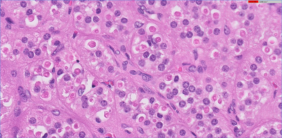 slusagar's tweet image. #endopath: 
😍🔬aldosterone-secreting adrenal cortical adenoma (Conn syndrome), s/p prior Rx  w/spironolactone

add'l learning points: 
- number of spironolactone bodies typically peaks 4-6 week after spironolactone Rx 
- usually DO NOT see bodies with novel Rx agent eplerenone