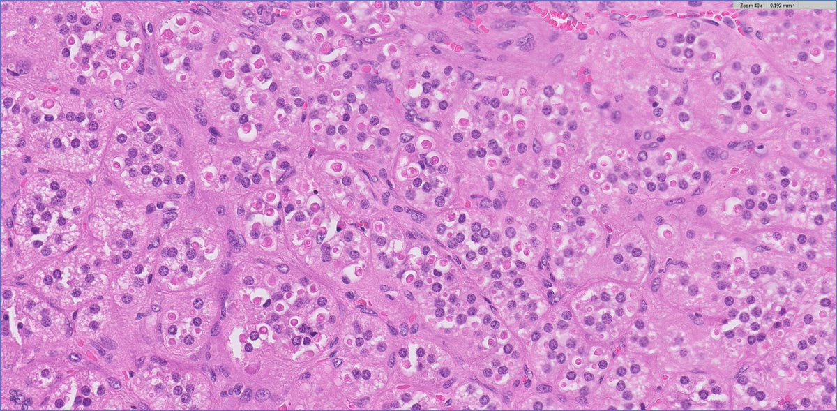 slusagar's tweet image. #endopath: 
😍🔬aldosterone-secreting adrenal cortical adenoma (Conn syndrome), s/p prior Rx  w/spironolactone

add'l learning points: 
- number of spironolactone bodies typically peaks 4-6 week after spironolactone Rx 
- usually DO NOT see bodies with novel Rx agent eplerenone