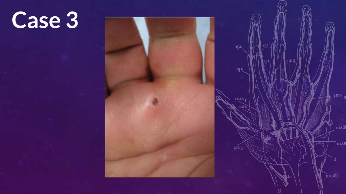 Here's a sneak peek of the cases discussed on the #orthoPAc podcast this week. Join us for part 2 of Hand Injuries Not To Miss, out tomorrow! 

paos.org/orthopacpodcast