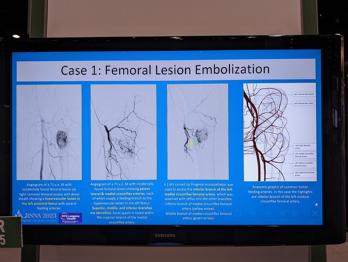 Terrific review of pre-op tumor embolization from superstar medical student @shinipatel36 . Her time with @NYUImaging as a @nyuVIR research intern turned out some great projects at #RSNA2023 #RSNA23 @NYURadRes @btaslakianMD