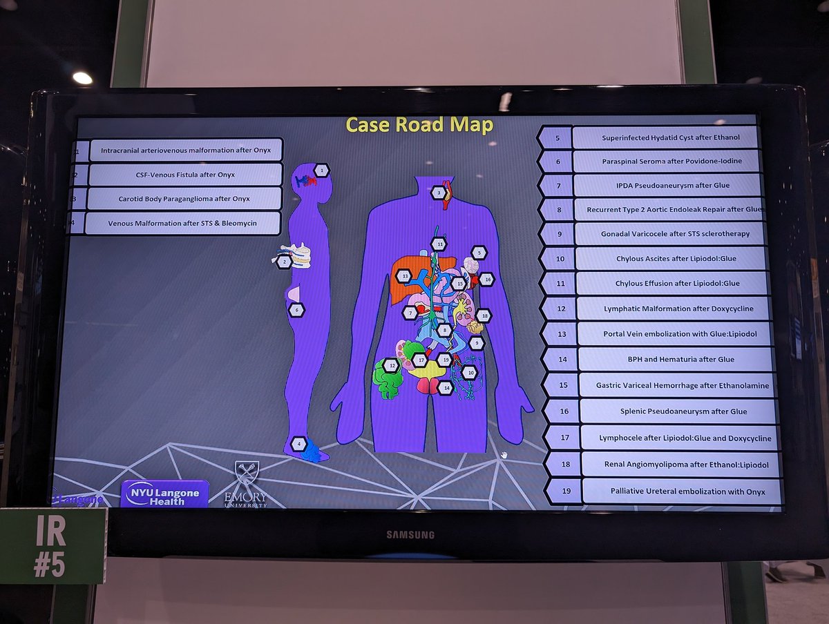 A comprehensive review of the gamut of liquid agents that #IRad used for embolization procedures and their imaging appearances from superstar #IRadres Keith Ameyaw @NYURadRes @nyuVIR @NYUImaging #RSNA23 #RSNA2023