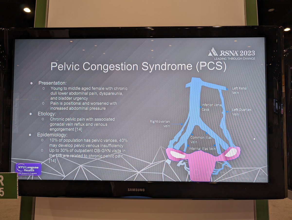 Younes Attlassy (MS3) @nyugrossman and future #radiology resident dropping some knowledge on the nuances of pelvic and gonadal vein embolization at #RSNA2023 #RSNA23. Terrific to have such great medical undergrad trainees on the #irad train. @NYURadRes @NYUImaging