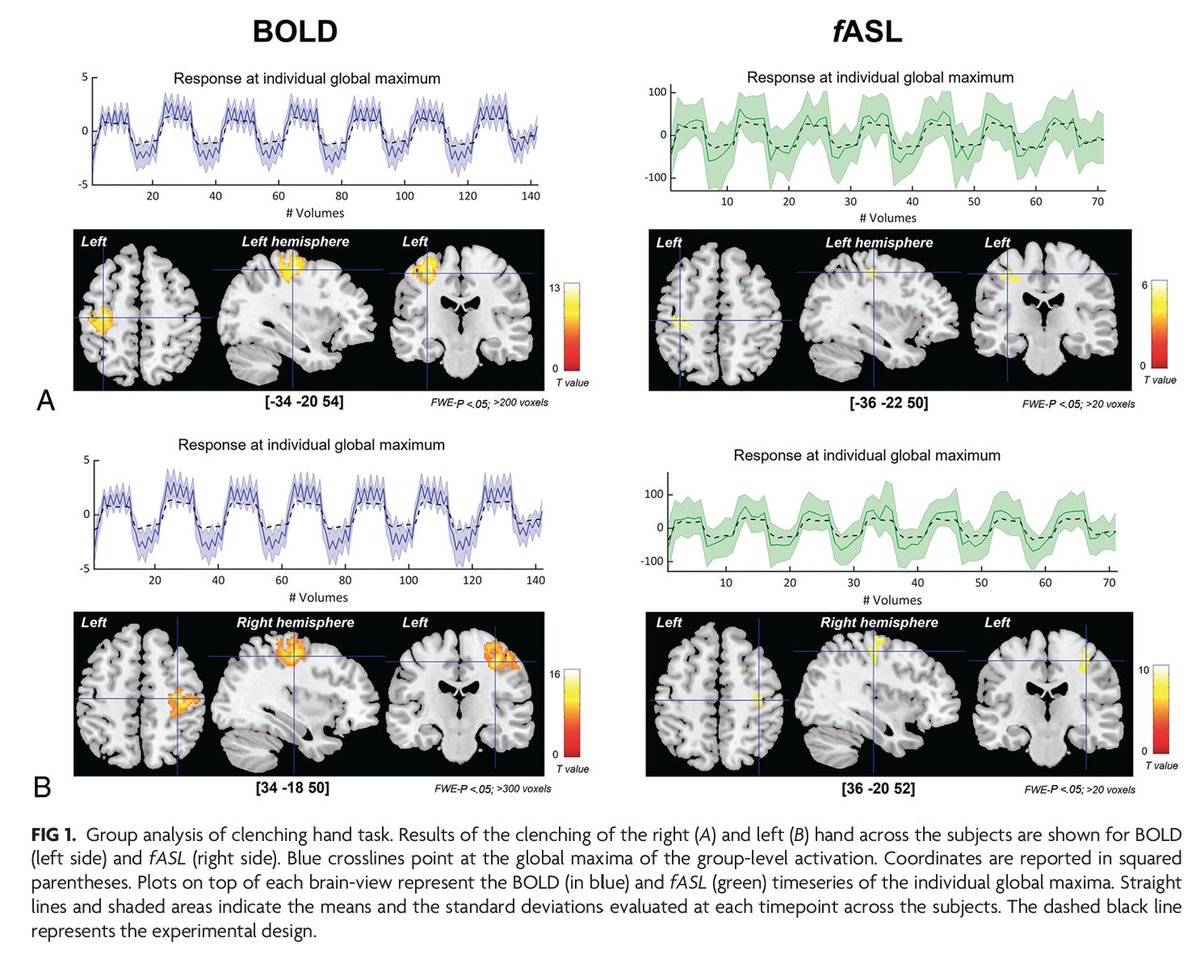 AJNR (@theajnr) on Twitter photo "Specificity of Quantitative Functional Brain Mapping with Arterial Spin-Labeling for Preoperative Assessment" #ASL #OpenAccess #EditorsChoice <a href="/theASFNR/">American Society of Functional Neuroradiology</a> <a href="/GrouillerF/">Grouiller Frédéric</a> | ajnr.org/content/44/11/… "Specificity of Quantitative Functional Brain Mapping with Arterial Spin-Labeling for Preoperative Assessment" #ASL #OpenAccess #EditorsChoice <a href="/theASFNR/">American Society of Functional Neuroradiology</a> <a href="/GrouillerF/">Grouiller Frédéric</a> | ajnr.org/content/44/11/…