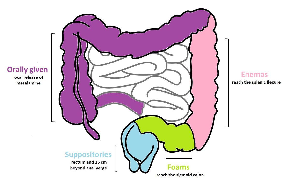 drkeithsiau's tweet photo. Routes of mesalazine therapy in ulcerative colitis 💡

https://t.co/2wAPYkhe0k https://t.co/fjur7ClUaw