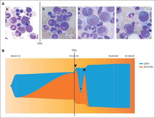 Sanam Loghavi, MD صنم لغوی 🔬🧬 (@sanamloghavi) on Twitter photo Now this is cool
#VEXAS vs #CML 🤺
#hemepath #MPNSM
I’m always fascinated by the war of clones.. even though the winners and losers are often too predictable.
shorturl.at/AHLR4
<a href="/BloodAdvances/">Blood Advances</a> Now this is cool
#VEXAS vs #CML 🤺
#hemepath #MPNSM
I’m always fascinated by the war of clones.. even though the winners and losers are often too predictable.
shorturl.at/AHLR4
<a href="/BloodAdvances/">Blood Advances</a>