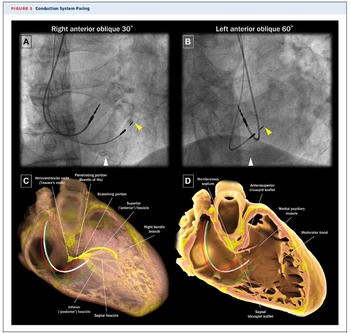 Cardiac Conduction System Pacing A Comprehensive Update @JACCJournals EP Since the initial description of His Bundle pacing targeting the conduction system, recent advances in pacing the left bundle branch and its fascicles have evolved jacc.org/doi/10.1016/j.…