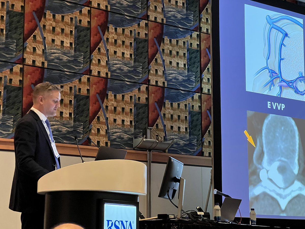 At RSNA2023. Dr. Peter Kranz crushing CSF-venous fistula imaging, like so many epidurally injected lumps of glue and blood.
