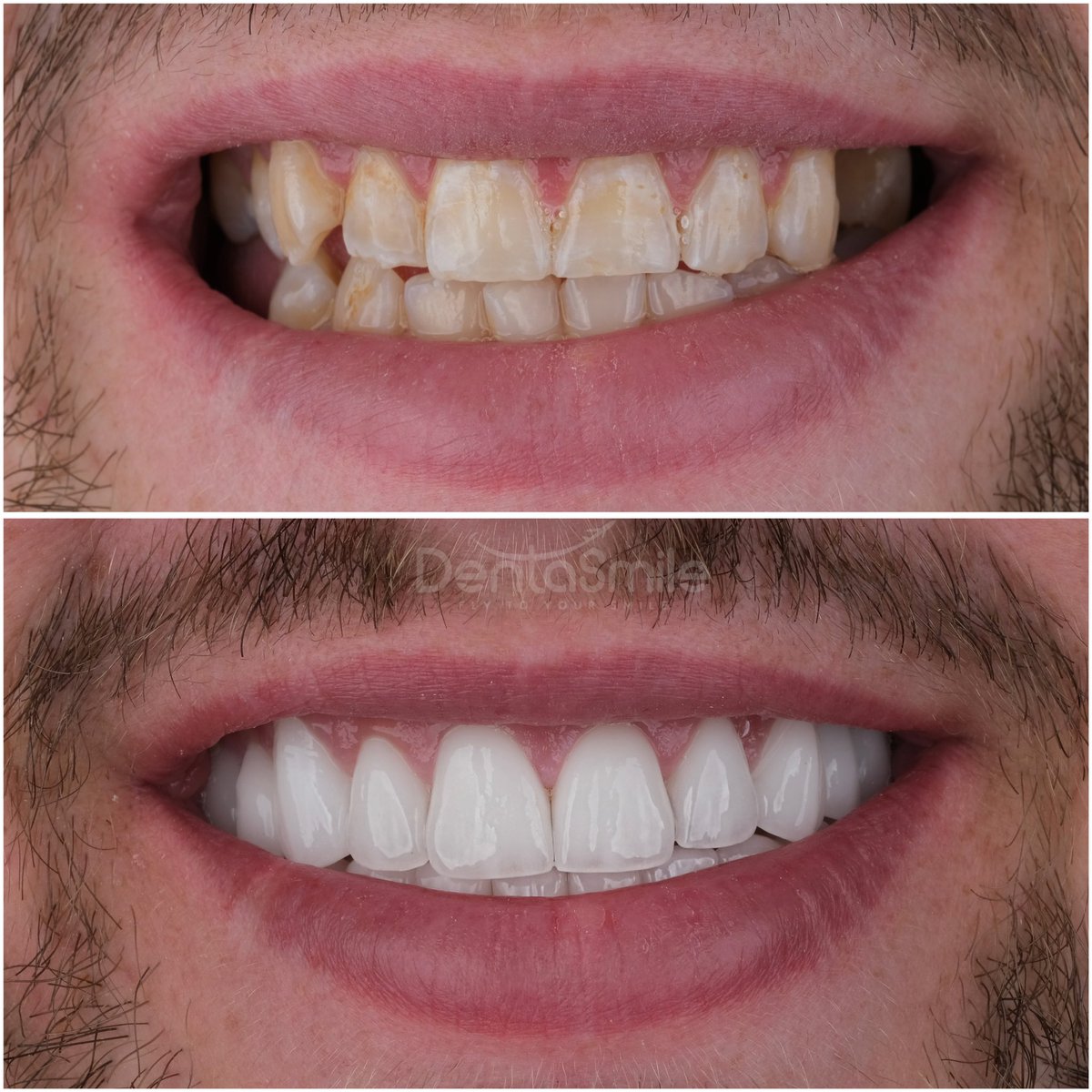 dentasmiletr's tweet photo. We finished the new smile design and Implants treatment of our patient Liam From London. 🇬🇧✈️

🦷 Zirconia Crown &amp; Smile Makeover &amp; Implant Treatment.
🏨 5 Stars Hotel Accomodation included
🚐 VIP Airport-Hotels-Clinic transfers included.
☀️ Vacation in Beautiful Antalya https://t.co/jk1v3W0o4N