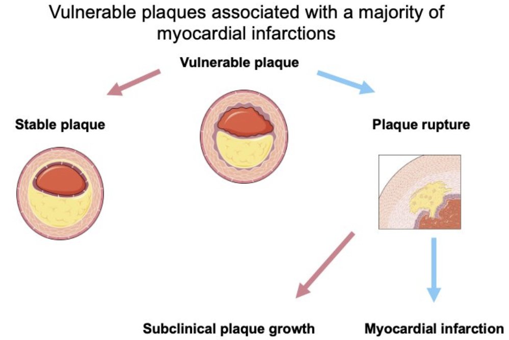 urotoday's tweet photo. Androgen receptor agonist versus antagonist: cardiac morbidity. Great presentation from @CaPsurvivorship @DanaFarber. #SUO23 written coverage by @RKSayyid @UofT on UroToday > https://t.co/hTprW4YwQK @UroOnc #SUO2023 https://t.co/FnXf6Vd0GQ