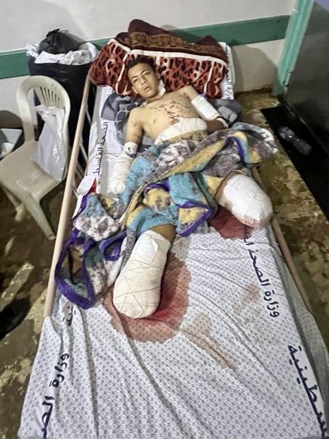 Yazen is 14 years old. He lost three limbs from an American bomb that hit his home in #Gaza.  What do we do now?  We heal him, body and soul. It’s a long-term commitment that requires dedication after the shock of him lying in his own blood wears off. Who’s with me? 🇵🇸✌️☮️
