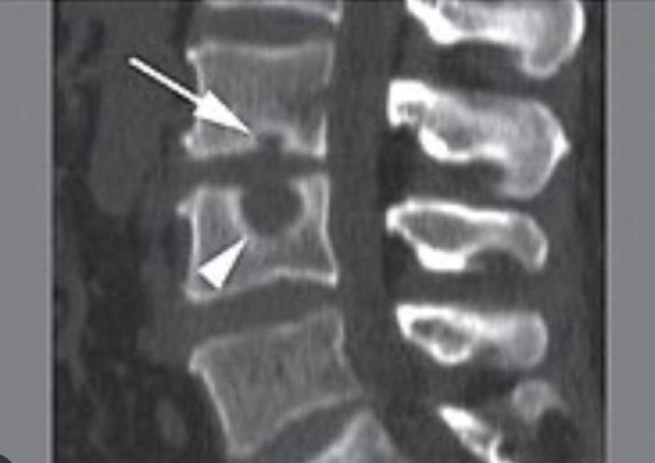 A patient presented for evaluation of back pain. Imaging revealed this finding. What is the likely diagnosis? #MedX