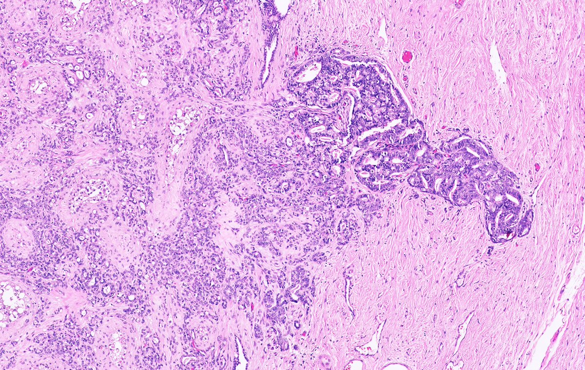 #slidearchiveseries metastatic prostatic adenocarcinoma to testis #gupath #pathtwitter #pathoutpic

🔬 intertubular growth, LVI
1️⃣ usually solitary, unilateral tumors
🤯 may mimic primary tumor (rete adenocarcinoma, Sertoli cell tumor)
⚠️ frequent absence of known primary tumor