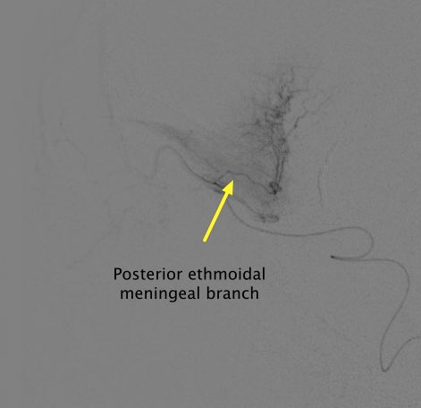 Important to know and understand the dangerous anastamoses around the #MMA. What better way to understand than through #transophthalmic #tumorembo #iloveneurosurgery #cerebrovascular #neuroIR #neuroendovascular