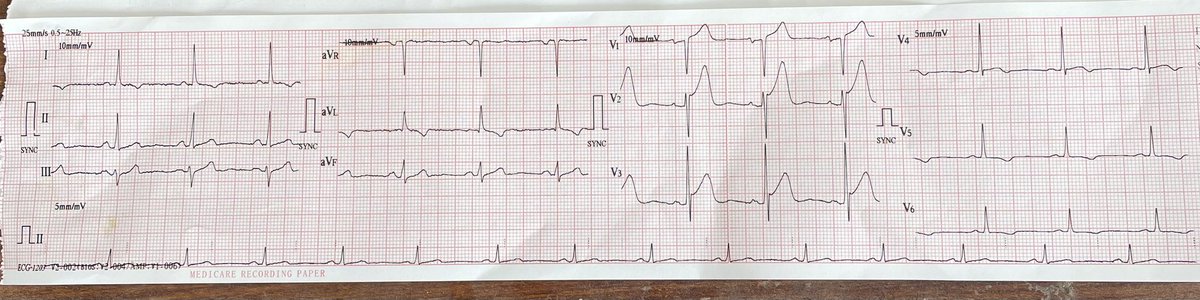 A 60 yr old male..smoker for 20 years presented with shoulder pain..pain was atypical off and off..Bp was 170/110..Following ecg @EM_RESUS @smithECGBlog @ECGfan ..hyperacute t waves?