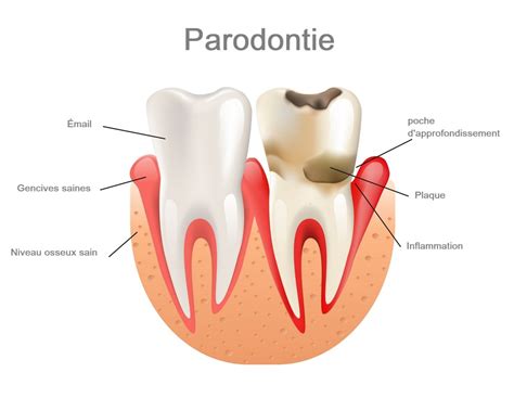 1/ Une personne m'a envoyé ceci, en expliquant comment elle a réussi à se débarrasser de la parodontie, je le partage donc avec vous car je sais que cela est un fléau, ma mère en souffrait, je l'ai vu perdre ses dents, pourtant en bonne santé, les une après les autres, merci 🙏