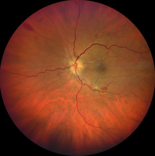 OphthaKarger's tweet photo. Bilateral Optic Disc Swelling with Persistent Visual Loss in Anemia: Case Report
โก๏ธ https://t.co/FZJh0fcJOF
โ๏ธ Kim Van Langenhove and Marcel Paulus Maria Ten Tusscher
๐ #CaseRepOphthalmol
#OpenAccess https://t.co/nC67puFIXa