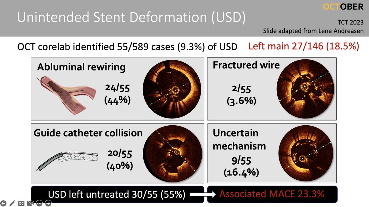 @GreggWStone @JHRo67 @sbrugaletta @PCRonline @SripalBangalore @Drroxmehran @DLBHATTMD @JACCJournals @escardio @shci_sec @secardiologia @TCTMD @mmamas1973 @NievesGonzalo1 @ColletCarlos @MaeharaAkiko Even 'expert' operators still have room for improvement! Pre-specified analysis of OCTOBER demonstrated unintended stent deformation in 10% (1 in 5 left main PCIs) & only 50% were detected by operators