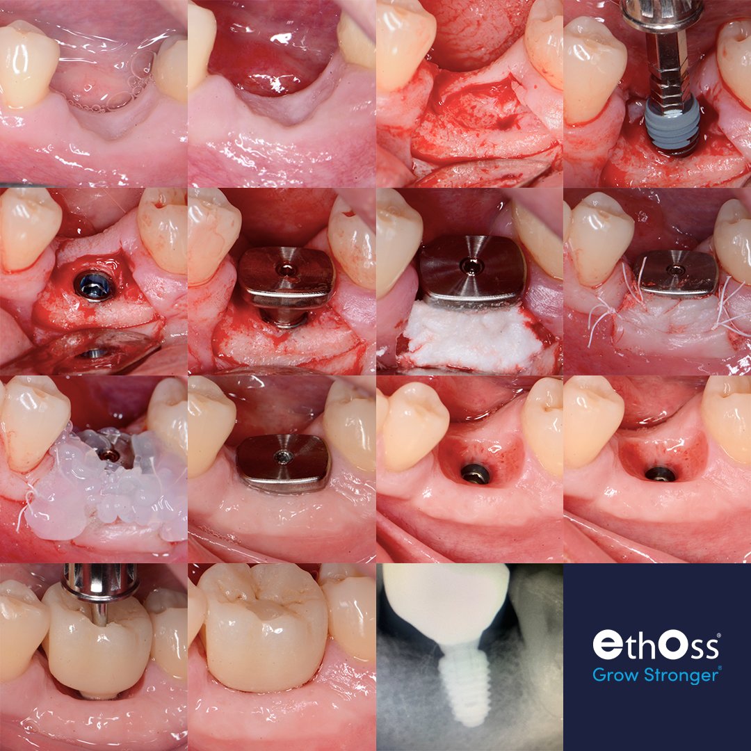 EthossCo's tweet image. Check out this case study from Dr Peter Fairbairn

Got questions? Ask him in the EthOss Case Studies Group - hubs.la/Q02bdbnq0

#ethosscasestudies #dentalimplantcasestudy #ethossbonegraft #dentalbonegraft #growstronger #dentalimplantcommunity