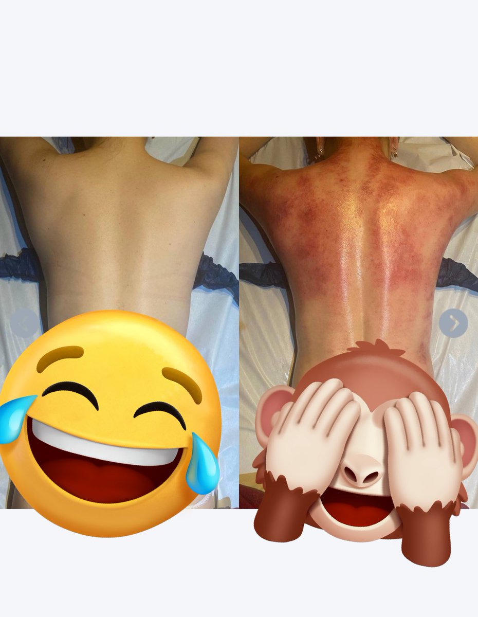 ずっと行きたかった<a href="/speed_bijin/">Speed美人｜スピード美人｜セルライトクラッシュ　ハーブピーリング通い放題</a> 
一言でおすすめです。痛かったけど私は痛みに強い。アザがやっぱ出来たけど3日くらいで薄くなるみたい。セルライト潰れてる感あって気持ち良かった。来週も行くの楽しみだな。痩せますように。年末まで少しでも細く見えるように通います。