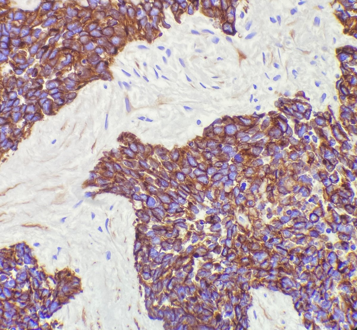 Keratin expression does not necessarily indicate carcinoma. Some sarcomas, such as this desmoplastic small round cell tumor (DSRCT), show extensive keratin immunoreactivity. Important to consider sarcomas in the differential diagnosis for keratin-positive tumors. #BSTpath