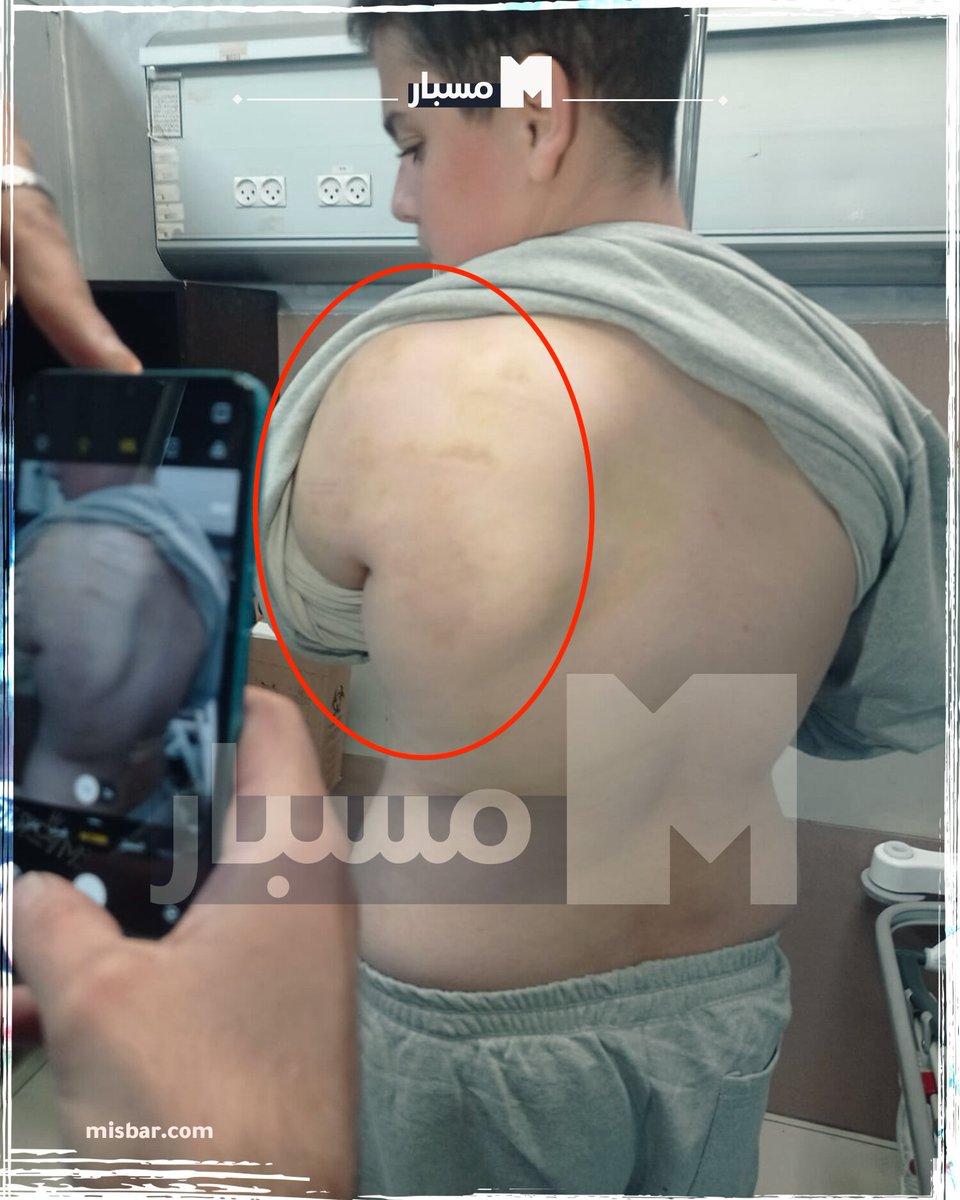 muhammadshehad2's tweet image. 5\ UPDATE: Mohammed Nazal&apos;s medial record was just released: showing broken &amp;amp; fractured fingers, contusions in his arms &amp;amp; bruises on his back.

The report recommends &quot;surgical fixation&quot; to correct the fingers that were broken &amp;amp; left for days without treatment.