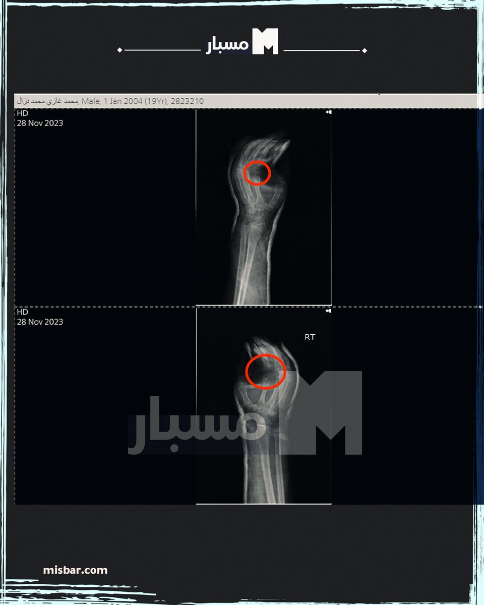 muhammadshehad2's tweet image. 5\ UPDATE: Mohammed Nazal&apos;s medial record was just released: showing broken &amp;amp; fractured fingers, contusions in his arms &amp;amp; bruises on his back.

The report recommends &quot;surgical fixation&quot; to correct the fingers that were broken &amp;amp; left for days without treatment.