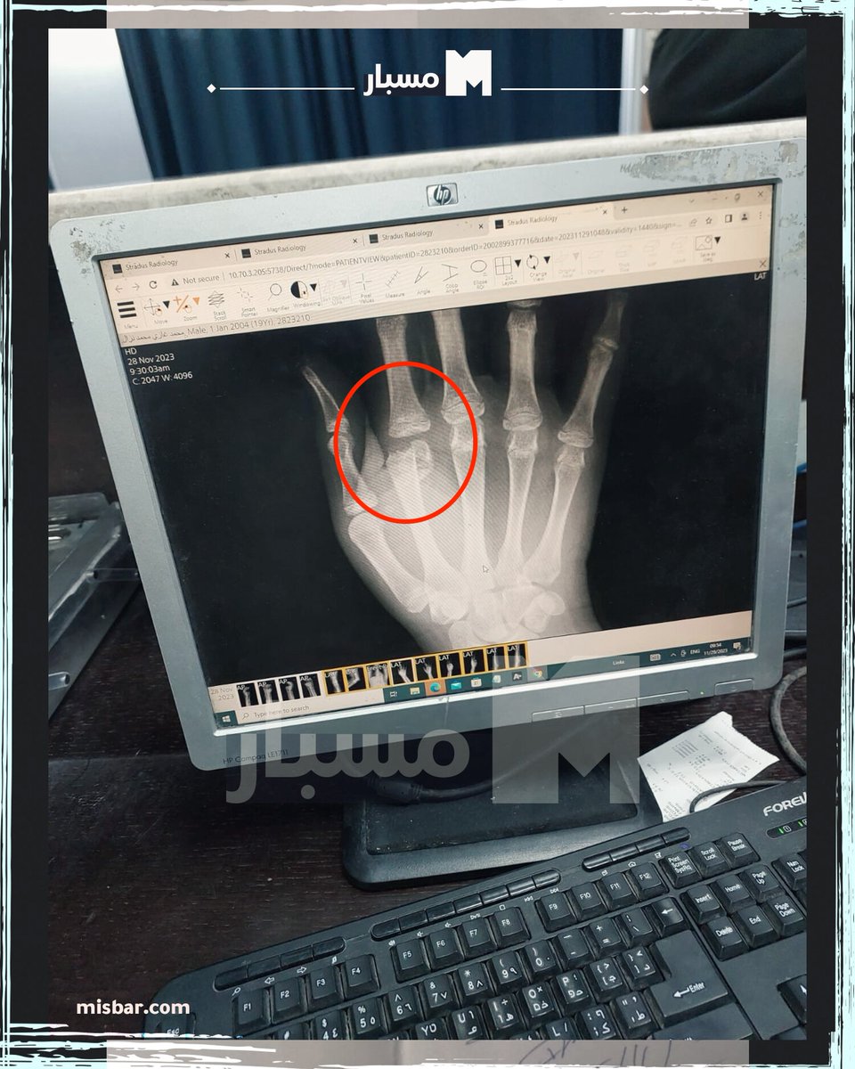 muhammadshehad2's tweet image. 5\ UPDATE: Mohammed Nazal&apos;s medial record was just released: showing broken &amp;amp; fractured fingers, contusions in his arms &amp;amp; bruises on his back.

The report recommends &quot;surgical fixation&quot; to correct the fingers that were broken &amp;amp; left for days without treatment.