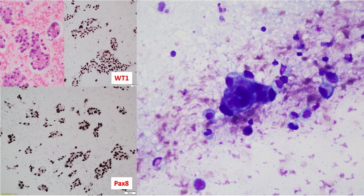 #UABCyto case by Dr. Nicholas Paul: 74 y/o F with pleural effusion. Hyperchromatic cell groups with irregular nuclear contours and cytoplasmic vacuolization. Calretinin-, WT1+, PAX8+. Dx: metastatic endometrial serous carcinoma, c/w surgical resection.