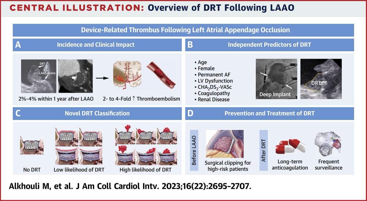 Dive into this #JACCINT State-of-The-Art Review discussing #DRT post #LAAO! What are the clinical implications, classification and management of DRT? 🧐 bit.ly/3sViEk2 #AFib #CardioTwitter @DrHodaHatoum @Anders_K_H @adnanalkhouli