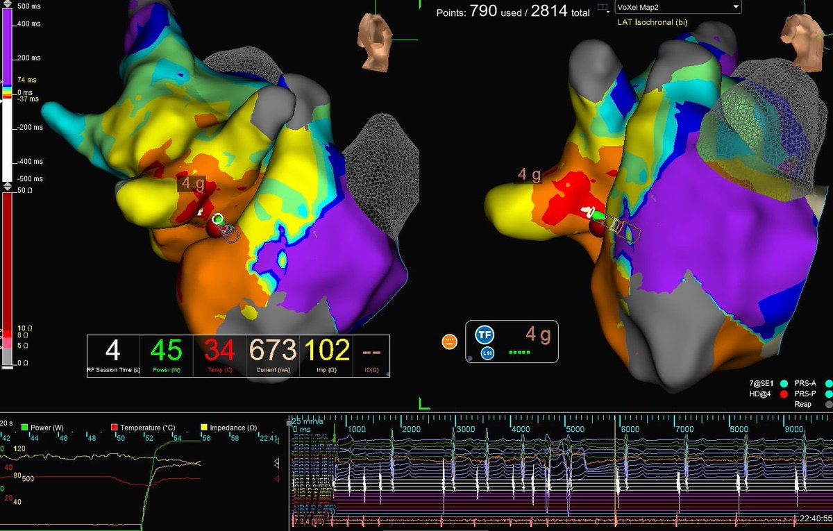 Good to be getting things done #zerofluoro #epeeps. Left septal APCs/ AT ablated. @szufski1, thanks for covering. No lead, happy fellow @rraven8. 😊