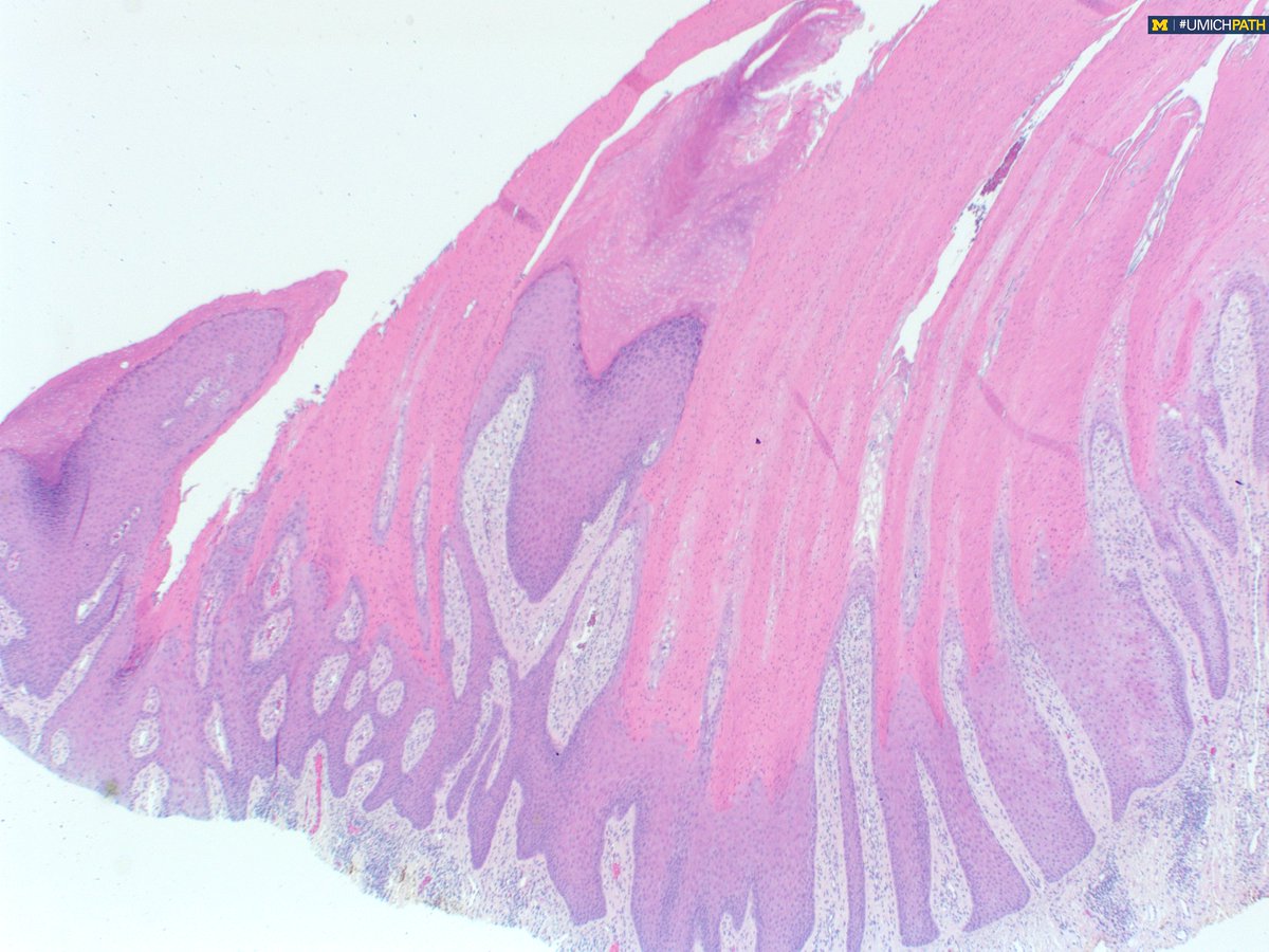 UMichPath's tweet image. #COTW with PGY1 @meredithkherman featuring a variant in #dermpath.  Shave biopsy of groin lesion. What histologic features do you see? What is your differential diagnosis?