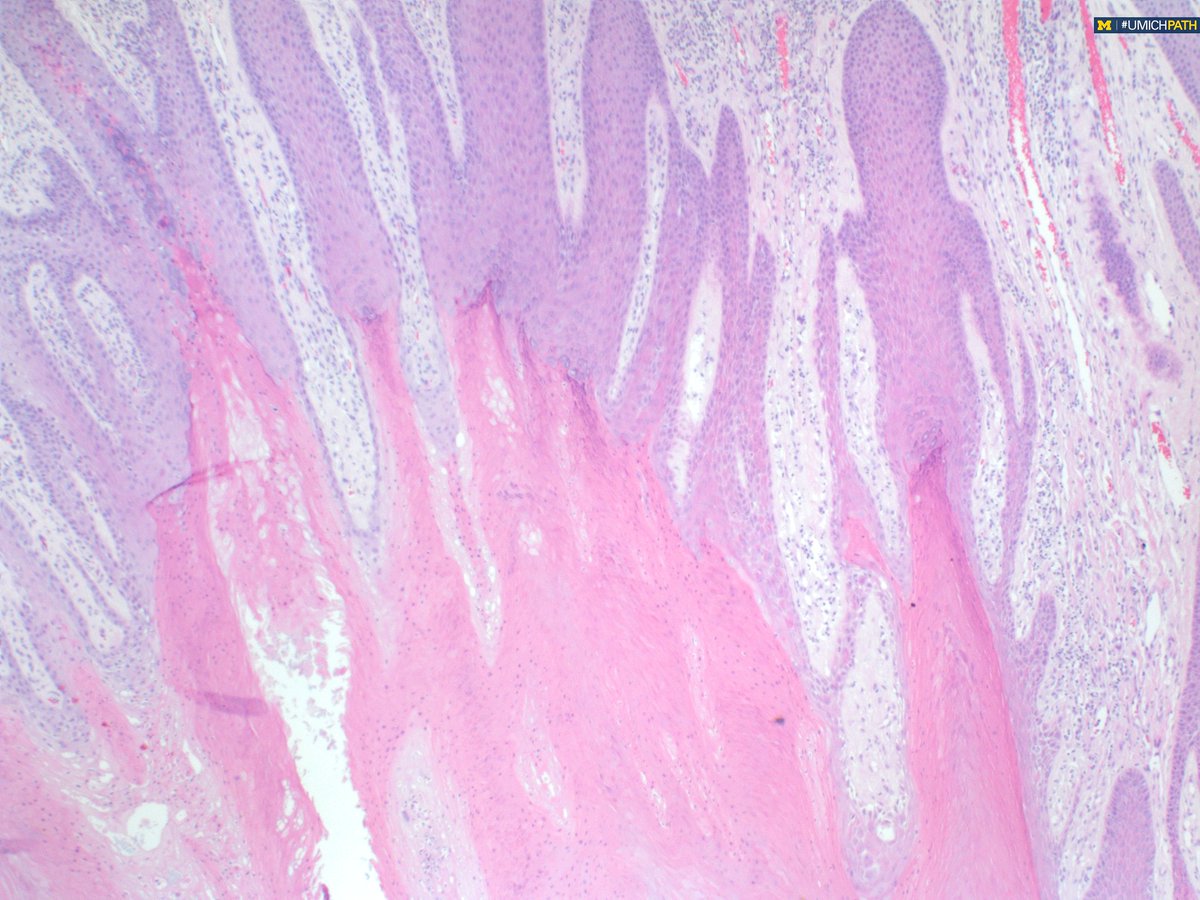 UMichPath's tweet image. #COTW with PGY1 @meredithkherman featuring a variant in #dermpath.  Shave biopsy of groin lesion. What histologic features do you see? What is your differential diagnosis?