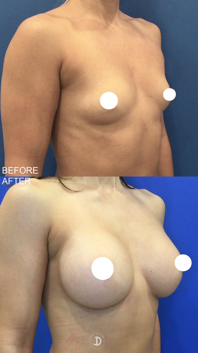 Results of an Infinity Breast Augmentation!