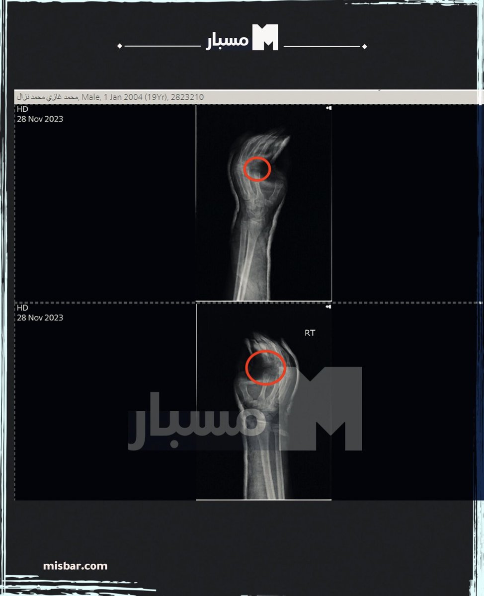 ShaykhSulaiman's tweet photo. BREAKING: MEDICAL RECORDS OF MOHAMMAD NAZAL SHOW HE WAS TELLING TRUTH ABOUT BROKEN ARMS, FINGERS AND BEING BEAT

The report shows he had fractures in his fingers, contusions in his right and left arms

His report states;

“X-ray showed RT 2nd Metacarpal Head Displaced Fracture & Left 2nd Metacaroipal Shaft Minimally displaced fracture trial of reduction and bilateral below elbow splint in positive hand plus position applied"

His back shows bruises consistent with his testimony that he was beaten up by prison guards

Nazal also said they were;

 - Beaten daily until a hostage died. 

- Given a plate of rice for 10 people to share

- Left to freeze without any heating.

- He was beaten up

- He was starved daily

- He was left without medical treatment