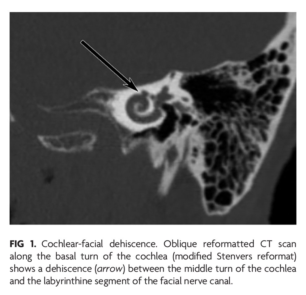 'Prevalence of Cochlear-Facial and Other Non-Superior Semicircular Canal Third Window Dehiscence on High-Resolution Temporal Bone CT' #Tbone #FellowsJournalClub @ASHNRSociety @CharBranstetter | ajnr.org/content/44/11/…