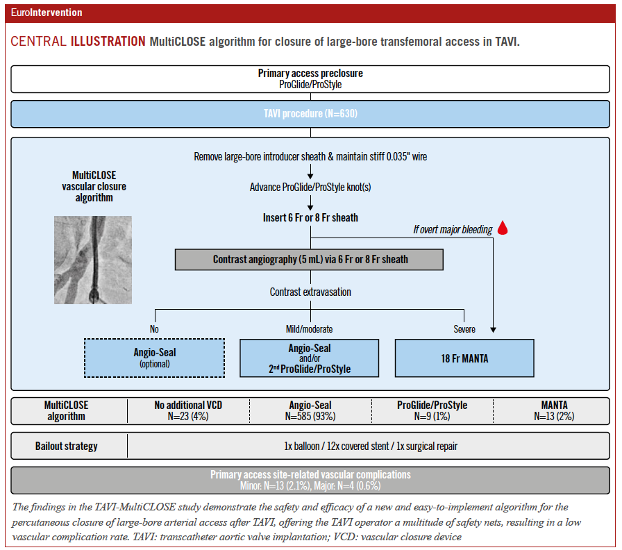The TAVI-MultiCLOSE study demonstrated the safety and efficacy of a new and easy-to-implement algorithm for percutaneous closure of large-bore arterial access after TF-TAVI. Read more. #EAPCI  ow.ly/qFoO50QcuNi
