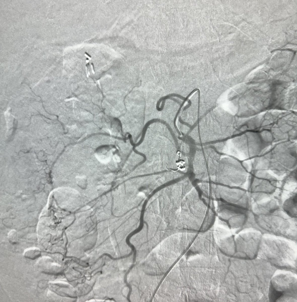 Ahmed Kamel MD, PhD, FSIR (@ahmed_kamel_ir) on Twitter photo Trauma patient with pseudo aneurysm in the pancreatic head supplied by ileal branches of the superio mesenteric artery, and embolized with Gelfoam and coils <a href="/UTHouston_IR/">UT Houston_IR</a> <a href="/UTHradiology/">UTHealth Houston Radiology</a> <a href="/HCIRad/">Houston Combined IR Residency</a> <a href="/kumar/">Legal</a> <a href="/ajgunnmd/">AJ Gunn</a> @IR_juniors <a href="/ETF_IRtrainees/">CIRSE European Trainee Forum</a>
#Trauma #Pseudoaneurysm #Embolization. Trauma patient with pseudo aneurysm in the pancreatic head supplied by ileal branches of the superio mesenteric artery, and embolized with Gelfoam and coils <a href="/UTHouston_IR/">UT Houston_IR</a> <a href="/UTHradiology/">UTHealth Houston Radiology</a> <a href="/HCIRad/">Houston Combined IR Residency</a> <a href="/kumar/">Legal</a> <a href="/ajgunnmd/">AJ Gunn</a> @IR_juniors <a href="/ETF_IRtrainees/">CIRSE European Trainee Forum</a>
#Trauma #Pseudoaneurysm #Embolization.