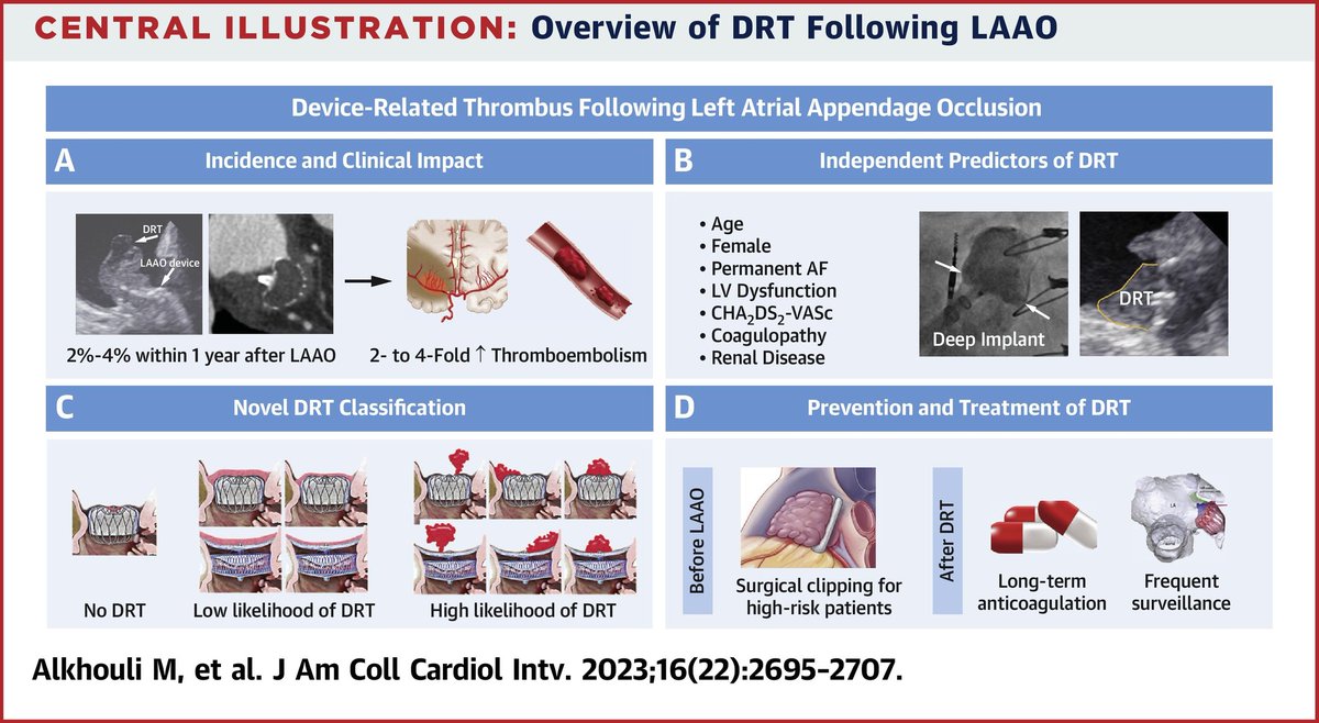 Device-Related Thrombus After Left Atrial Appendage Occlusion: Clinical Impact, Predictors, Classification, & Management
State-Of-The-Art Review
jacc.org/doi/10.1016/j.…
#cardiology #MedEd #medtwitter #CardioTwitter #CardioEd #2023review #2023reviewarticle #CardioTuiteros